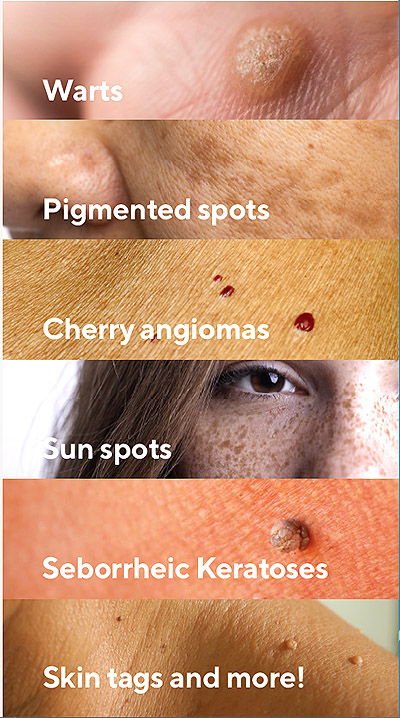 cryopen skin treatment types